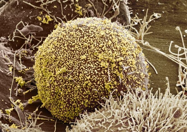 Người phụ nữ đầu tiên trên thế giới khỏi HIV nhờ liệu pháp cấy tế bào gốc