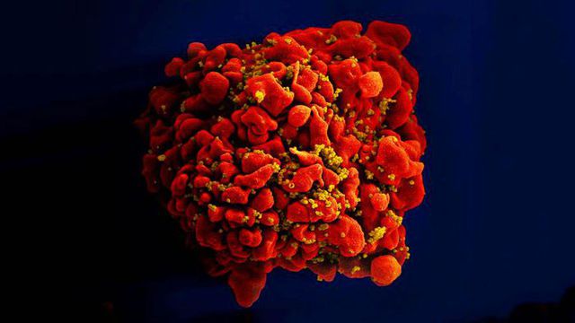 Phát hiện chủng virus HIV mới với độc lực cao ở Hà Lan