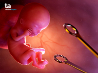 17 câu hỏi cần lưu ý khi nạo phá thai 3 tháng đầu