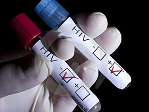 Dấu hiệu nhận biết nhiễm HIV/AIDS