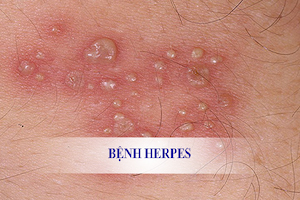 Bệnh do virut Herpes, dùng thuốc gì?