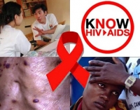 Dấu hiệu nhận biết mình bị nhiễm HIV