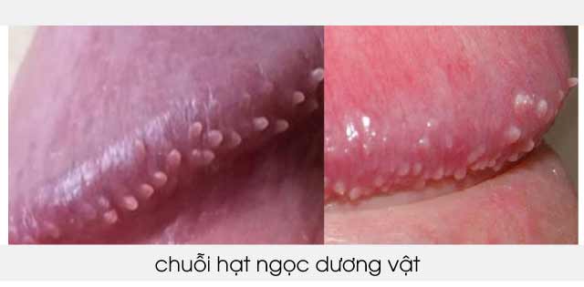 Chuỗi hạt ngọc dương vật: Sinh lý hay bệnh lý?