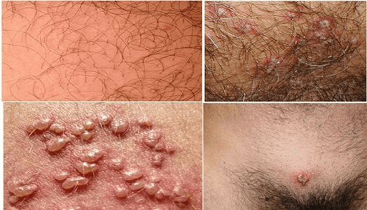 Coi chừng Herpes sinh dục dễ lây truyền