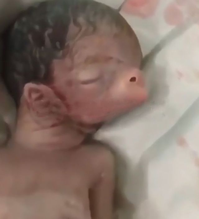 Em bé sinh ra với tai và mũi lợn