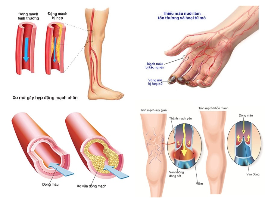 Nhận biết sớm viêm tắc động mạch, tránh biến chứng