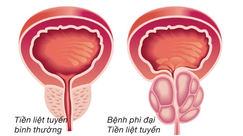 Quan hệ tình dục ở người bị phì đại tuyến tiền liệt