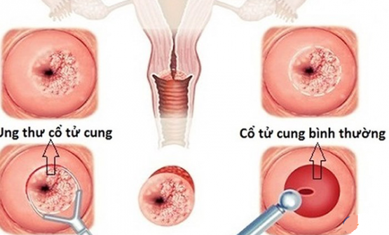 Những điều cần biết về ung thư cổ tử cung