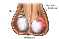 Nguyên nhân bất ngờ gây teo tinh hoàn ở nam giới