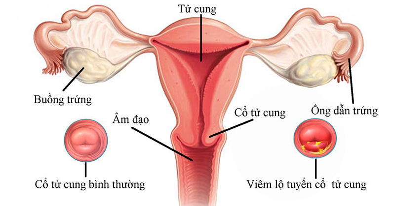 Viêm lộ tuyến cổ tử cung độ 1 có nguy hiểm không cách điều trị là gì?