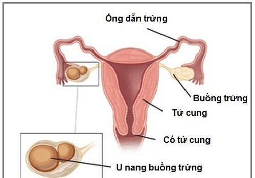 Thực hư u nang buồng trứng gây tăng cân? Liệu có đáng ngại?