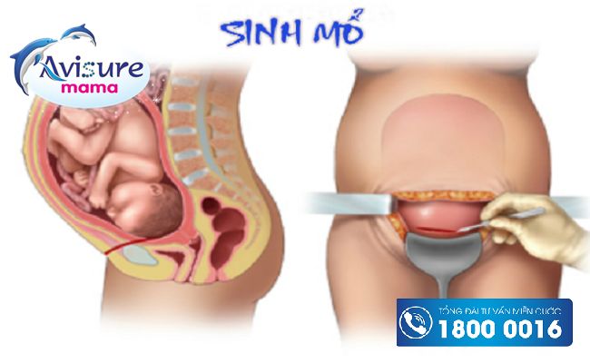 Sinh mổ ảnh hưởng đến sức khỏe mẹ và con hơn sinh thường