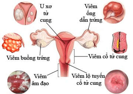 Các bệnh thường gặp ở tử cung