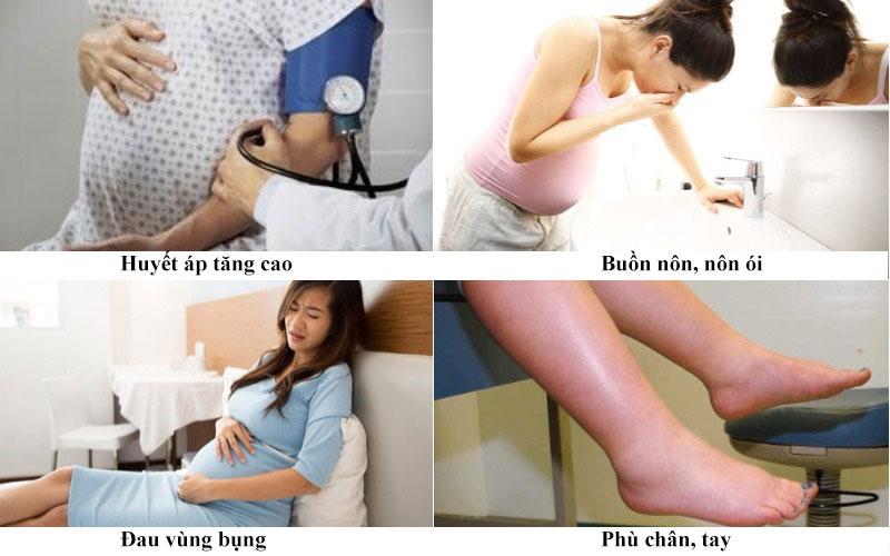 Những dấu hiệu tiền sản giật mẹ bầu cần ghi nhớ