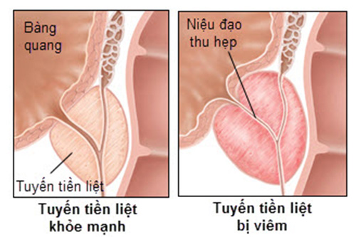 Biểu hiện của bệnh lậu ở nam giới ở giai đoạn đầu