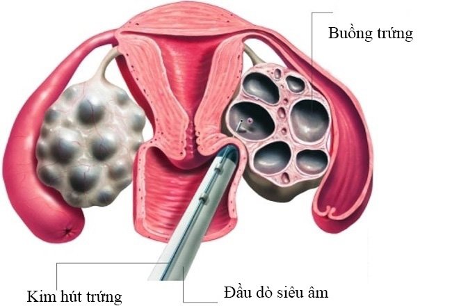 Sau chọc trứng bao lâu thì quan hệ tình dục?