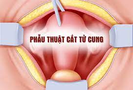 Những biến chứng sau khi cắt tử cung