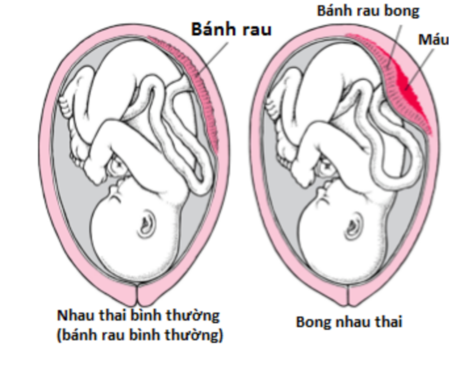 Thai 9 tuần bị bong bánh rau có tự hết được không?