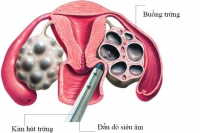 Các tác dụng phụ của thuốc kích trứng khi làm IVF