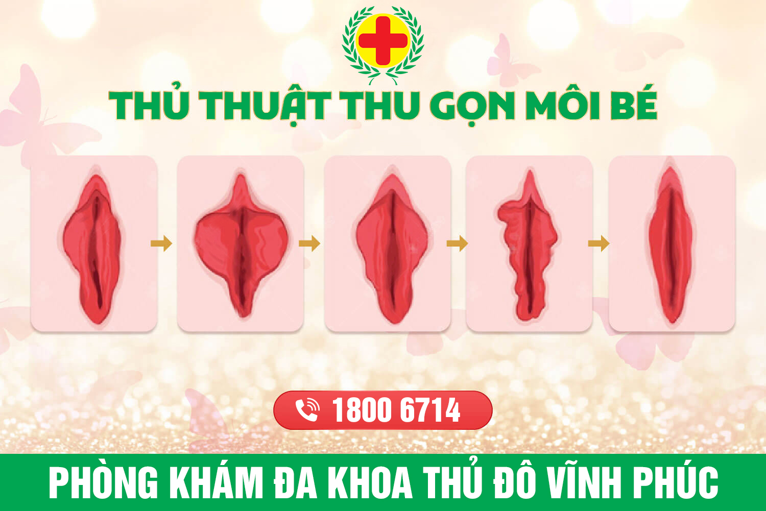 Sự thật về phẫu thuật màng trinh không phải ai cũng biết