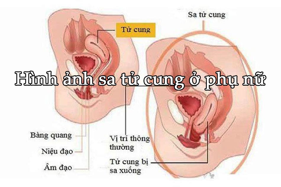 Sau sinh ngồi nhiều có bị sa tử cung không - chuyên gia giải đáp