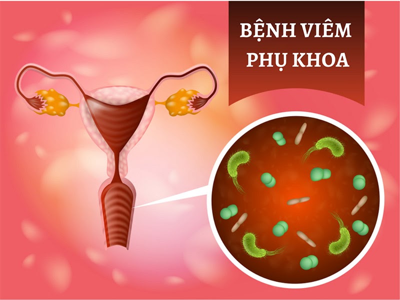 Dấu hiệu viêm phụ khoa nặng – nhẹ và giải pháp khắc phục