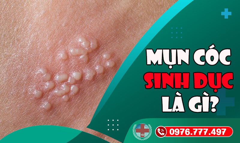 Mụn cóc sinh dục và những biến chứng nguy hiểm cần lưu ý