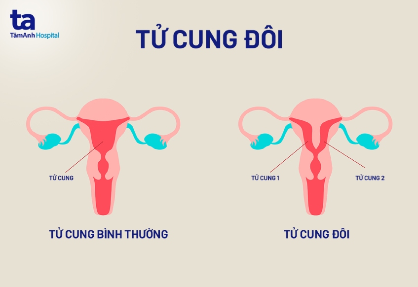 Bất thường ở tử cung ảnh hưởng đến khả năng sinh sản