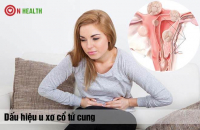 Có thể xác định loại u xơ tử cung qua các dấu hiệu điển hình?