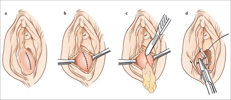 BỊ VIÊM TUYẾN BARTHOLIN CÓ TỰ KHỎI KHÔNG, NÊN LÀM THẾ NÀO?