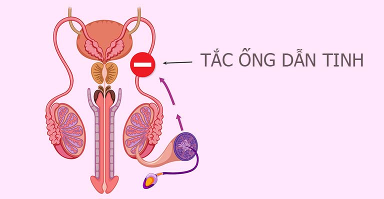 Tắc ống dẫn tinh là gì?