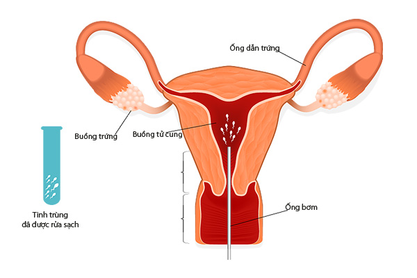 Khi nào nên thực hiện bơm tinh trùng vào buồng tử cung (IUI)?