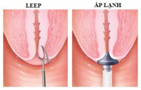 Đốt Lộ Tuyến Cổ Tử Cung Có Ảnh Hưởng Đến Khả Năng Sinh Sản