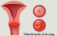 FAQ – Câu hỏi thường gặp Viêm lộ tuyến cổ tử cung có mang thai được không?
