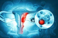 4 dấu hiệu chính cảnh báo ung thư cổ tử cung không nên bỏ qua