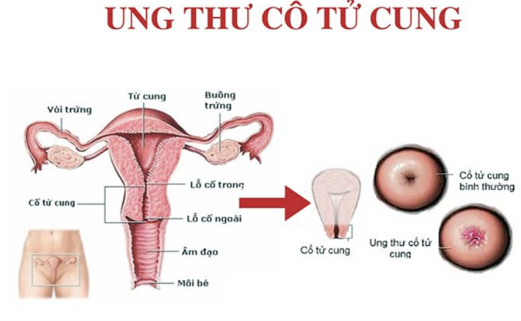 TẦM SOÁT UNG THƯ CỔ TỬ CUNG VÀ CÁC CÂU HỎI THƯỜNG GẶP