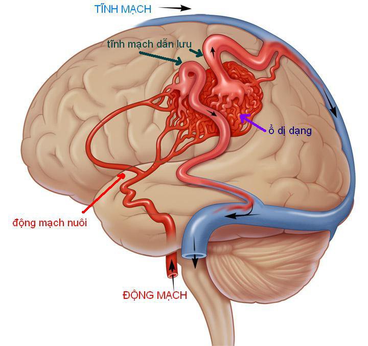 Chớ lơ là nếu bị đau đầu do quan hệ tình dục