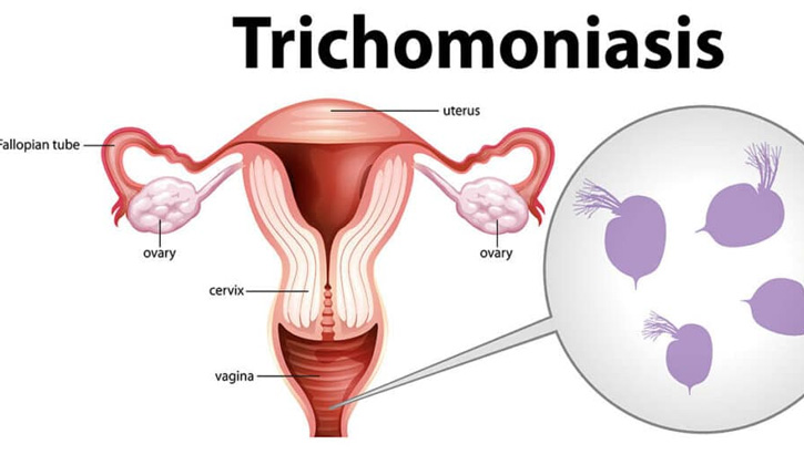 TÌM HIỂU VỀ BỆNH TRICHOMONIASIS